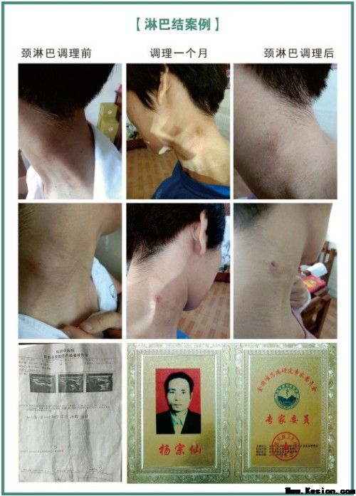 礼赞八一专题报道 著名国医大师---杨宗仙