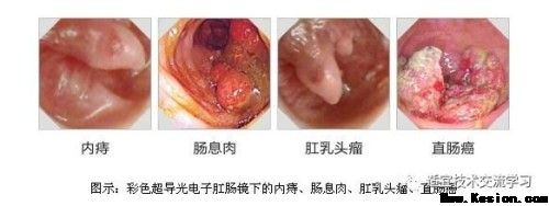 【5月10日】肛肠病穴位针挑疗法班~大胡子痔疮王雷虎成