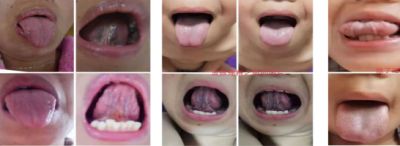 2024新春献礼专题报道 著名瑶医银疗推拿专家——周继辉