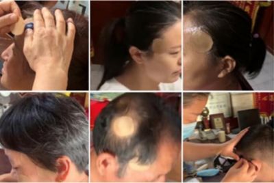 【观两会 论健康】   特别报道 头痛、头晕、三叉神经痛病专家——李东兰