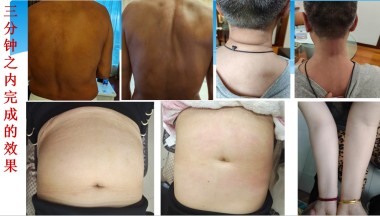 2025喜迎新春特别报道 中医骨膜消结术创始人---潘杏富