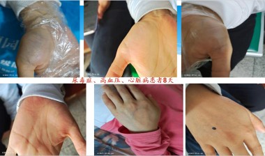 2025喜迎新春特别报道 中医骨膜消结术创始人---潘杏富